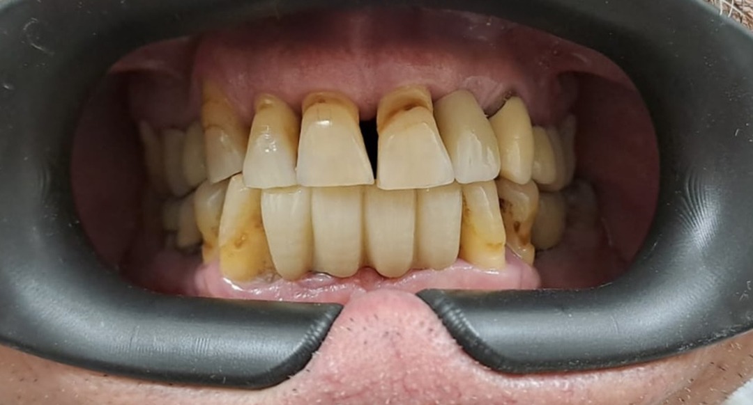 prueba-en-boca-gcfdental-