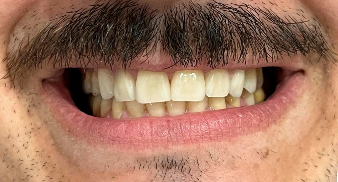 gcf-dental-lab-final-boca-