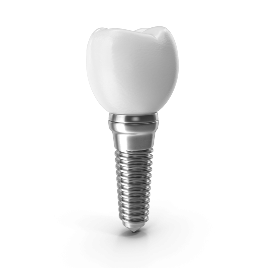 implante-3d-gcfdental implante-3d-gcfdental